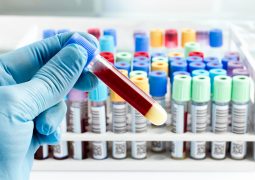 hand of a lab technician holding blood tube test and background a rack of color tubes with blood samples other patients / laboratory technician holding a blood tube test