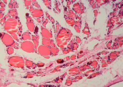 Cells of a human thyroid gland cells with goiter caused by deficiency of iodine under a microscope.