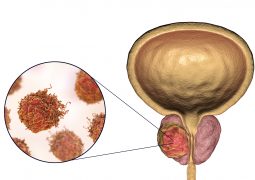 Prostate cancer, 3D illustration showing tumor inside prostate gland and closeup view of cancer cells