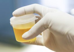 Healthcare And Medicine. Medical urine test, close-up